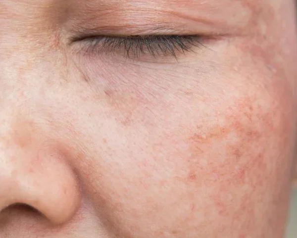 Pigmentation Disorders: What Causes Uneven Skin Tone?