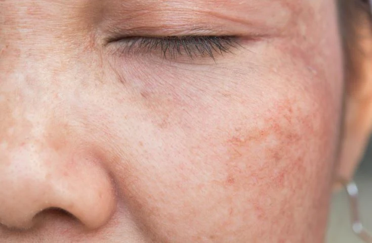 Pigmentation Disorders: What Causes Uneven Skin Tone?